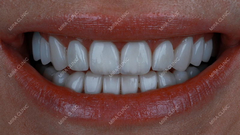 Smile Design